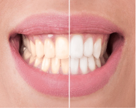teeth whitening newmarket sun lake dental care